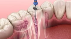 Root-Canal-Treatment - Profuct Images