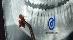 akkel dat - pain -extraction - Dentidoor case 01