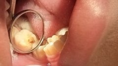 before filling dental caries - 01