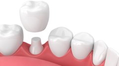tooth-colored-dental-crown